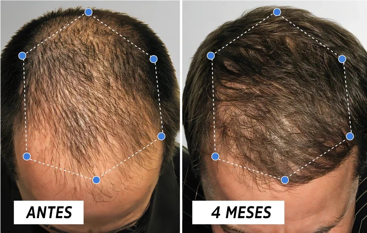 NOVA - Crecimiento del cabello con Péptidos de Cobre III